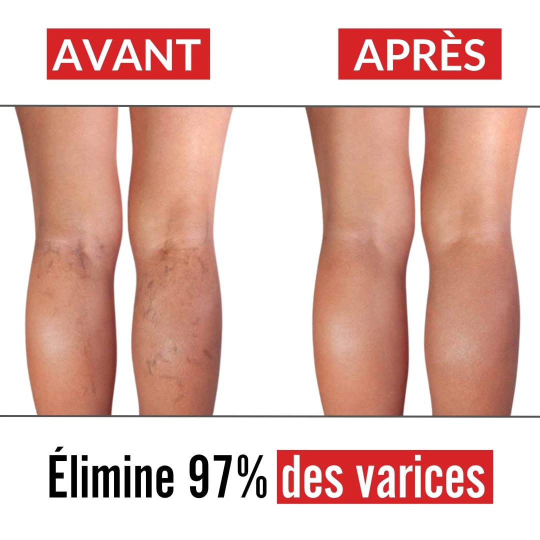 Crème anti-varice et jambes lourdes | Yoderma®